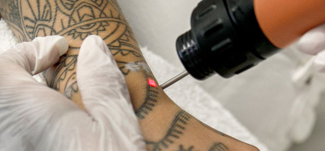 Tattoo Entfernung Ab 2020 Nur Noch Bei Arztinnen Und Arzten